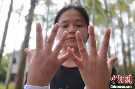 吳素英展示被蜜蜂蜇過的雙手。湯曉逵 攝