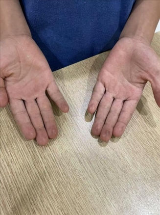 9歲小學生長期拍煙卡，手部粗糙長繭。受訪者供圖