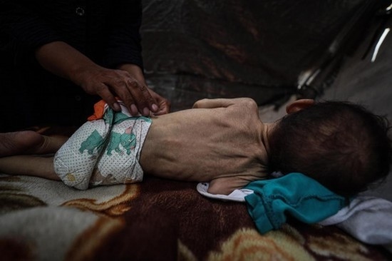 這是5月28日在加沙城西部一處臨時安置點拍攝的一名營養(yǎng)不良的嬰兒。新華社發(fā)（馬哈茂德·扎基攝）